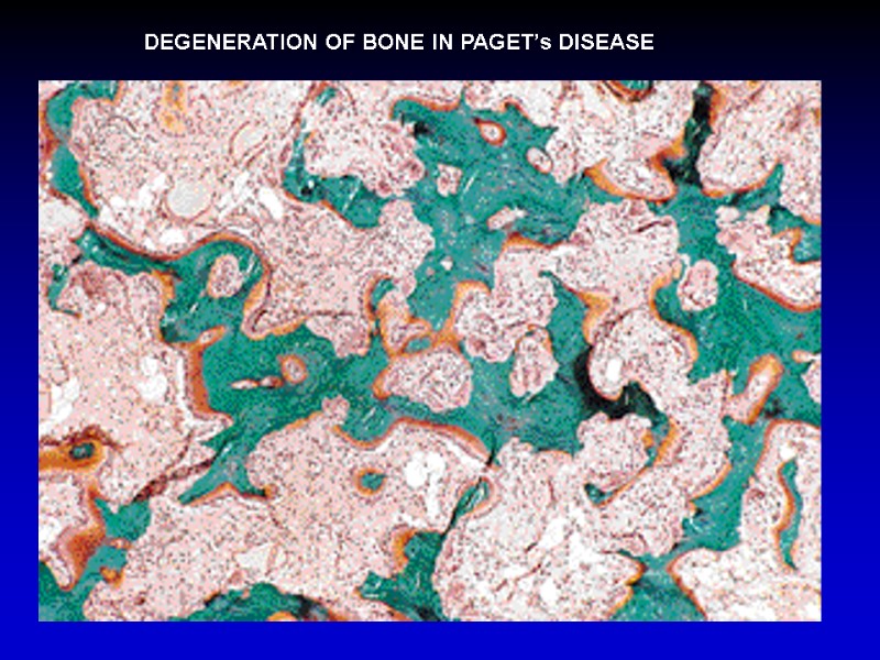 DEGENERATION OF BONE IN PAGET’s DISEASE